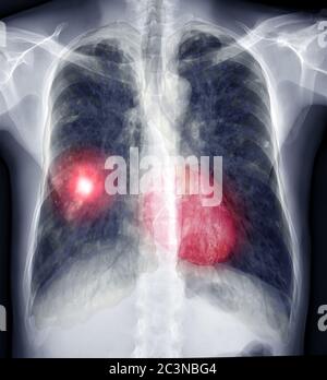 Immagine di fusione radiologica del torace con immagine di rendering 3D del torace o del polmone TC con cuore 3D per la diagnosi TB, tubercolosi e covid-19 . Foto Stock