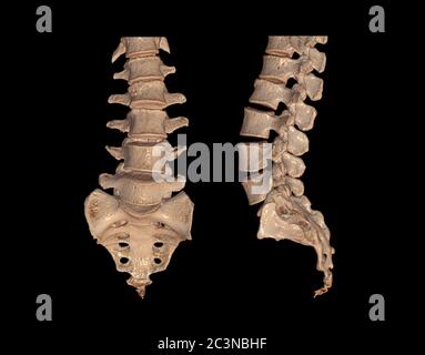 Raccolta di immagini di rendering 3D CT Lumbar o L-S spine AP e vista laterale che mostrano fratture di compressione a L2. Illustrazione 3D. Foto Stock