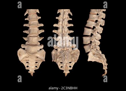 Raccolta di immagini di rendering 3D CT Lumbar o L-S spine Vista frontale, posteriore e laterale che mostra le fratture di compressione a L2. Illustrazione 3D. Foto Stock