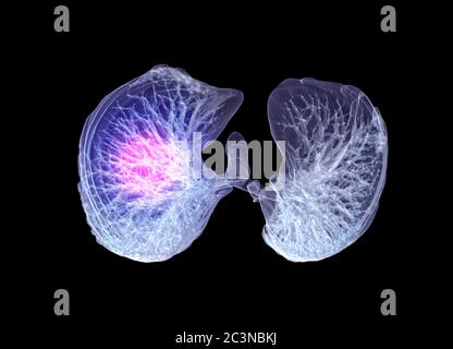 Visualizzazione pulsante dell'immagine di rendering TC torace o polmone 3D per la diagnosi TB, tubercolosi e covid-19 . Foto Stock