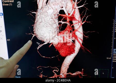 Il risultato della scansione del gatto cardiaco viene visualizzato sul monitor Foto Stock