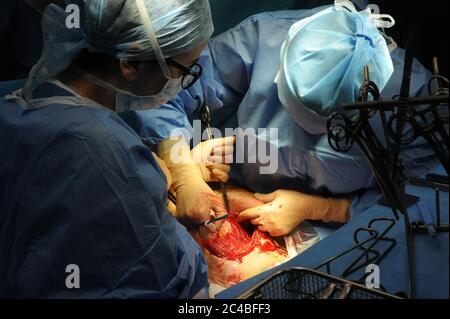 Rapporto presso l'ospedale di maternità dell'ospedale di Abbeville. Parto cesareo di una donna incinta con gemelli. Intervento programmato. Presenza in Foto Stock