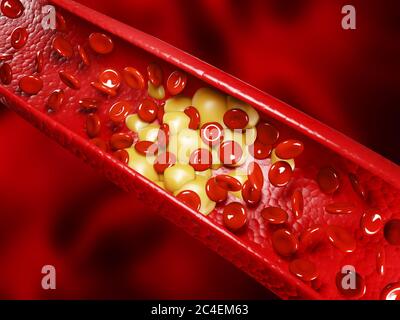 Globuli rossi umani sani e placche di colesterolo. concetto di rendering 3d Foto Stock