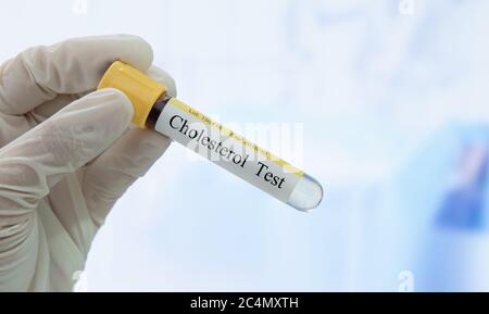Il medico tiene in laboratorio la provetta per il prelievo ematico del campione con l'etichetta per il test del colesterolo. Foto Stock