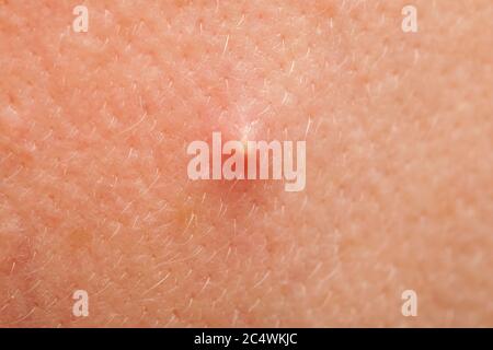 L'acne facciale infiammata sulla pelle della persona, primo piano. Foto Stock
