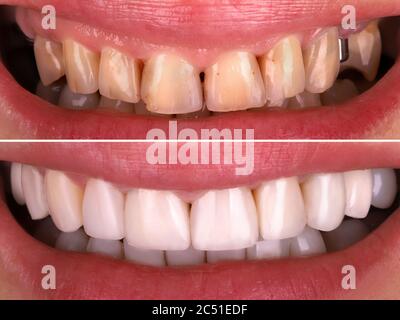 Sorriso perfetto prima e dopo la procedura di sbiancamento sbiancando di giovane donna sorridente felice . Clinica di trattamento di restauro dentale paziente.dimostrazione Foto Stock
