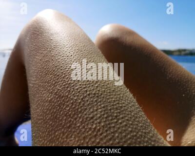 Primo piano di colpi d'oca sulle gambe di una donna, Bugibba, Malta Foto Stock