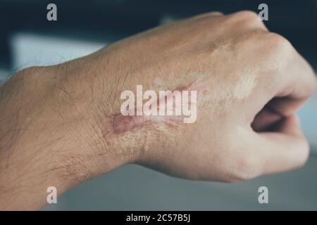 Cicatrice sulla pelle umana keloid a portata di mano. Foto Stock