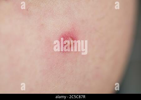 Pimple su infezione della pelle pimple a schioccare Foto Stock