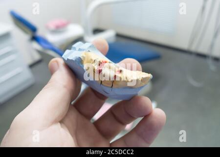 corone dentali in ceramica-metallo su un modello in gesso nelle mani del medico Foto Stock