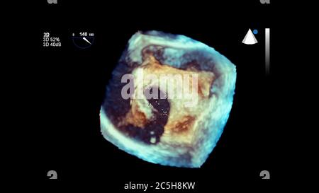 Immagine 3D del cuore durante l'ecografia transesofagea del cuore. Foto Stock