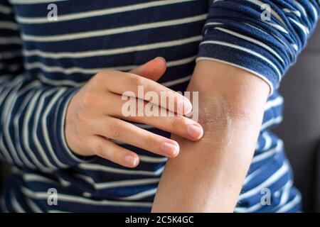 Primo piano le mani femminili applicando unguento sul braccio / gomito. Applicare una crema lenitiva nel trattamento e idratazione della pelle. Concetto di cura della pelle Foto Stock