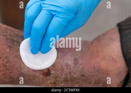 Primo piano immagine di una ferita infetta a piedi Foto Stock