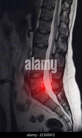 Immagine dopo l'esame dell'imaging di risonanza magnetica. Concetto di esame della colonna vertebrale, otseochondrosi, ernia intervertebrale lombare Foto Stock