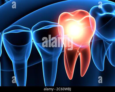 rendering 3d dei raggi x della ganascia con dente molare di distacco. Concetto di mal di denti. Foto Stock