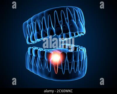rendering 3d dei raggi x della mascella con dente premolare di branconaggio. Concetto di mal di denti. Foto Stock