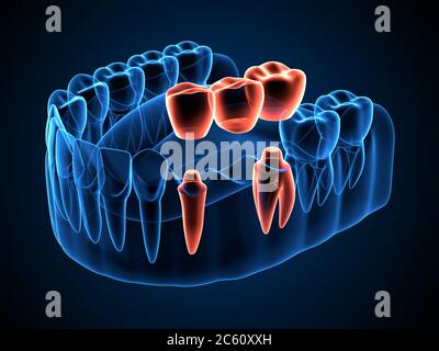 rappresentazione 3d dei raggi x della mascella con ponte dentale su denti molari e premolari Foto Stock