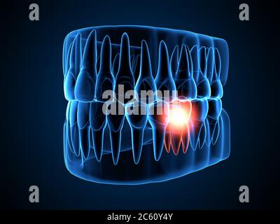 rendering 3d dei raggi x della ganascia con dente molare di distacco. Concetto di mal di denti. Foto Stock