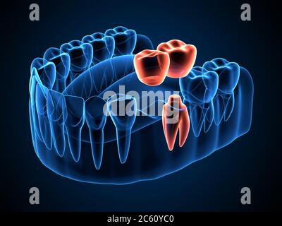 rendering 3d di raggi x mascelle con ponte a sbalzo dentale Foto Stock