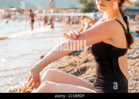 Una donna in costume da bagno si siede sulla spiaggia e la graffia mano con rossore e eruzione cutanea. Primo piano. Esterno. Concetto di punture di insetti e allergie. Foto Stock