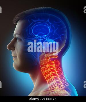 rappresentazione 3d, con precisione medica, di un maschio che ha un collo doloroso Foto Stock