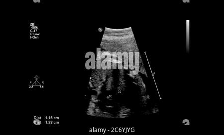 Schermo a ultrasuoni con ecocardiografia fetale. Foto Stock