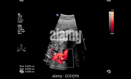 Schermo a ultrasuoni con ecocardiografia fetale. Foto Stock