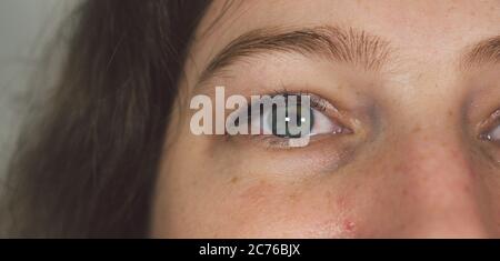 Donna con borsa sotto gli occhi. Occhio puffy della ragazza che mostra i sacchetti degli occhi. Occhi da vicino della donna. Foto Stock