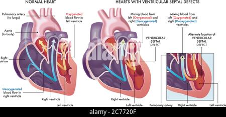 Illustrazione medica che confronta un cuore normale con i cuori afflitti da difetti settali ventricolari, un'apertura anormale (buco) nel cuore, con un Illustrazione Vettoriale