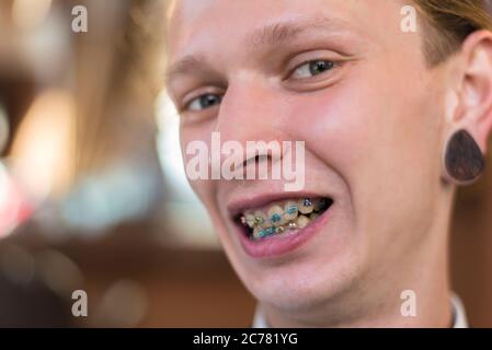 Ritratto di un ragazzo di venticinque anni con bretelle sui denti, sorridente. Morso sbagliato in un ragazzo sorridente giovane. Patologia dentale, correzione di Foto Stock