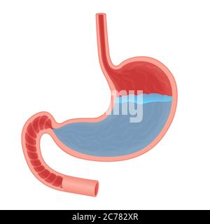 Vector illustrazione medica circa l'acido nello stomaco. Reflusso acido dello stomaco, acido gastrico Illustrazione Vettoriale