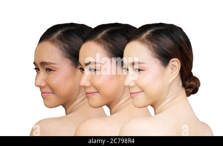 Tre immagini confrontate prima e dopo il trattamento per i fleckles, rimozione e guarigione dei punti di pigmento fleckles prima e dopo il trattamento laser in Asia Foto Stock