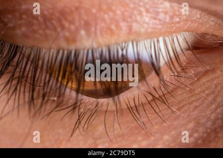 Foto macro occhio. Cheratoconus 4 gradi - malattia oculare, assottigliamento della cornea sotto forma di cono. La plastica cornea. Foto Stock