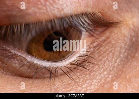 Foto macro occhio. Cheratoconus 4 gradi - malattia oculare, assottigliamento della cornea sotto forma di cono. La plastica cornea. Foto Stock