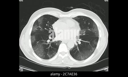 Tomografia computerizzata del torace (torace TC ad alta risoluzione) in un caso confermato di COVID-19 (virus Corona) che mostra variazioni in entrambi i polmoni Foto Stock