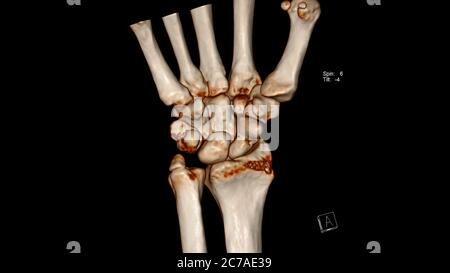 Esame radiologico, tomografia computerizzata Volume rendering esame dell'articolazione del polso (polso TC VR) che mostra una frattura dell'osso scapoide Foto Stock