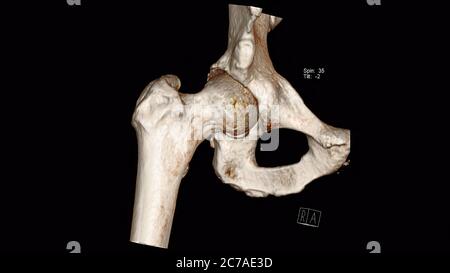 Esame del Volume rendering della tomografia computerizzata dell'anca (Anca CT VR) Foto Stock