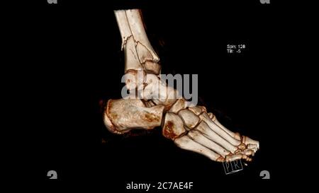 Immagine di rappresentazione volumetrica della tomografia computerizzata (CT VR) della frattura delle ossa delle gambe (tibia e fibula) sopra la caviglia, rappresentazione 3D Foto Stock