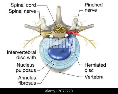 Illustrazione 3D che mostra un disco erniato doloroso o un disco scivolato Foto Stock