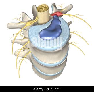 Illustrazione 3D che mostra un disco erniato doloroso o un disco scivolato Foto Stock