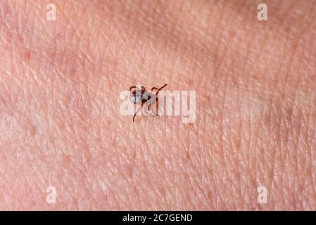 Spunta sulla pelle umana. Primo piano di un parassita, arachnid che cammina sul corpo umano. Foto Stock