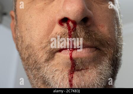 Sanguinamenti di naso , UN uomo sta sanguinando dal naso Foto Stock