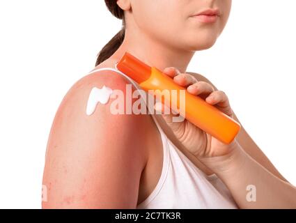 Donna con pelle scottata rossa che applica crema su sfondo bianco, closeup Foto Stock