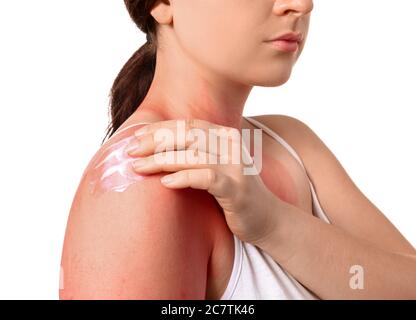 Donna con pelle scottata rossa che applica crema su sfondo bianco, closeup Foto Stock