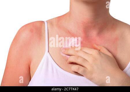 Donna con pelle scottata rossa che applica crema su sfondo bianco, closeup Foto Stock