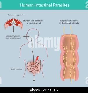 Parasiti intestinali umani. Illustrazione spiegare i parassiti nell'intestino tenue umano per causa di mangiare carne infetta o uova parassitarie nella carne Illustrazione Vettoriale