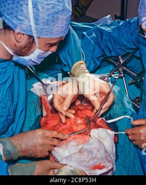 Bypass gastrico o operazione di "pinzatura tomach" su pazienti obesi morbilli. Foto Stock