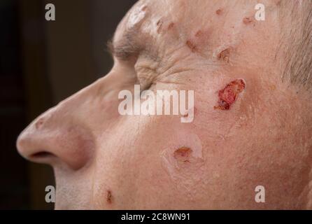 Ferita dal laser su un viso da dermatologo Foto Stock