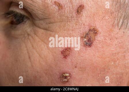 Ferita dal laser su un viso da dermatologo Foto Stock