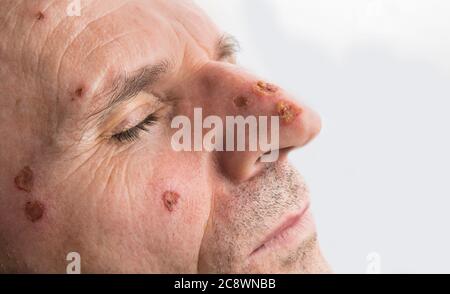 Ferita dal laser su un viso da dermatologo Foto Stock